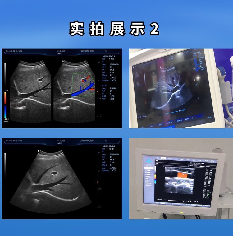 全数字推车彩超 黑白超 妇科B超 便携式笔记本超声新玛医疗_8962910a.jpg